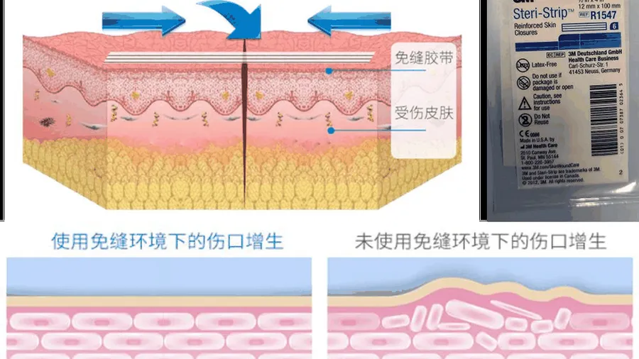 隆胸切口开在哪？乳晕、腋下、乳房下皱襞入路各有什么特点